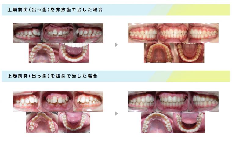 出っ歯の歯並びが気になる方へ‐鶴ヶ峰の矯正歯科　たけのうち矯正歯科