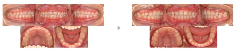 受け口の歯並びが気になる方へ‐鶴ヶ峰の矯正歯科　たけのうち矯正歯科