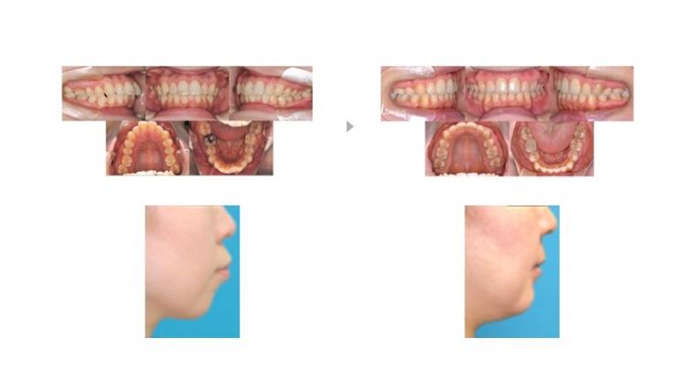 口元が出ているのが気になる方へ‐鶴ヶ峰の矯正歯科　たけのうち矯正歯科