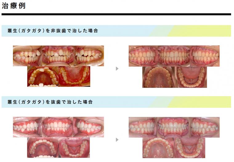 ガタガタの歯並びが気になる方へ‐鶴ヶ峰の矯正歯科　たけのうち矯正歯科