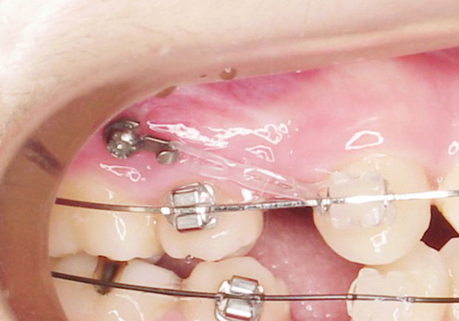 歯科矯正用アンカースクリューによる矯正とは